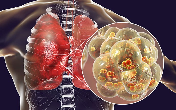 Áp xe phổi: Nguyên nhân, biểu hiện, cách điều trị và phòng bệnh