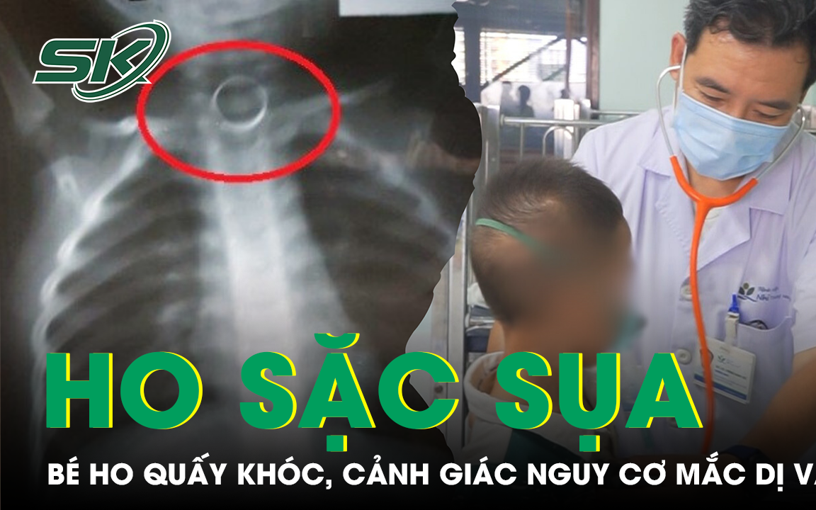 Trẻ ho sặc sụa, quấy khóc, đừng chủ quan với nguy cơ mắc dị vật