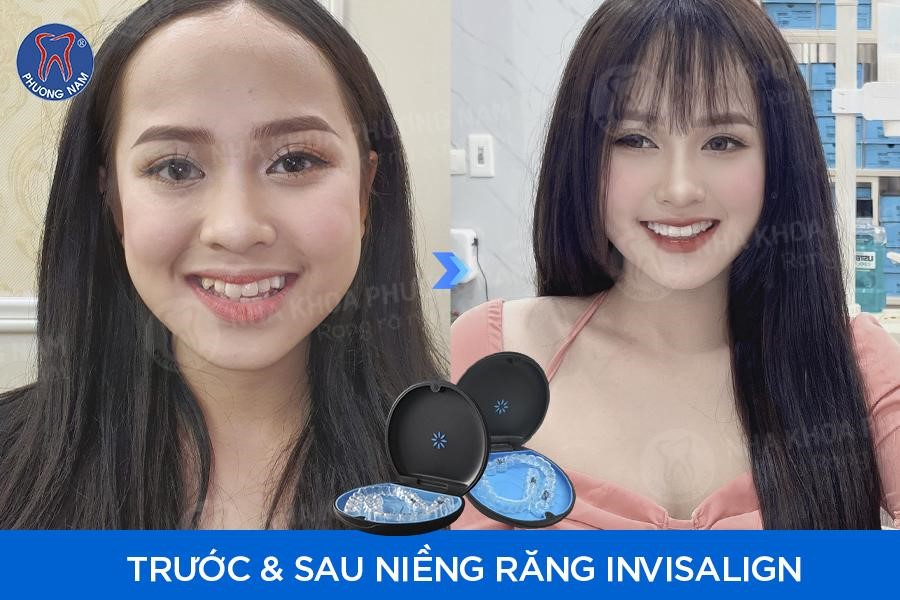 Bác sĩ Ngô Tùng Phương – thành công từ niềng răng trong suốt Invisalign, chỉnh nha không lộ mắc cài- Ảnh 3.