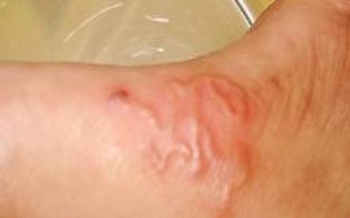 Nhiễm ấu trùng sán dây lợn từ thói quen ăn thực phẩm sống và cách phát hiện sớm- Ảnh 2.