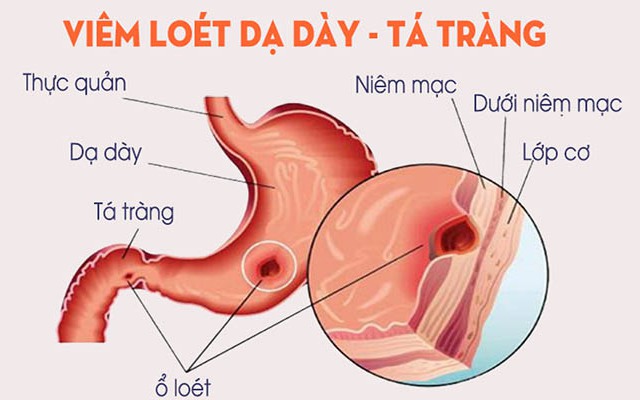 Nhận biết và phòng tránh viêm loét dạ dày tá tràng