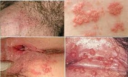 Câu hỏi liên quan bệnh Herpes sinh dục- Ảnh 2.