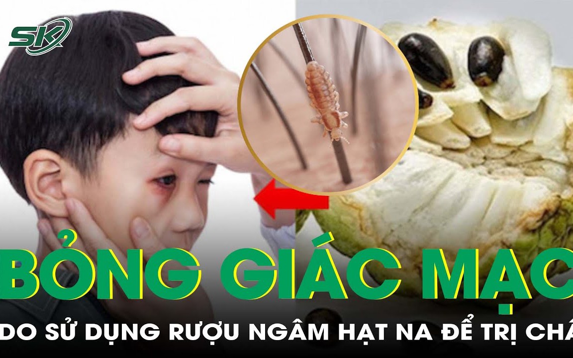 Bỏng kết giác mạc do sử dụng rượu ngâm hạt na để trị chấy