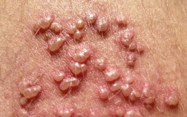 Câu hỏi liên quan bệnh Herpes sinh dục