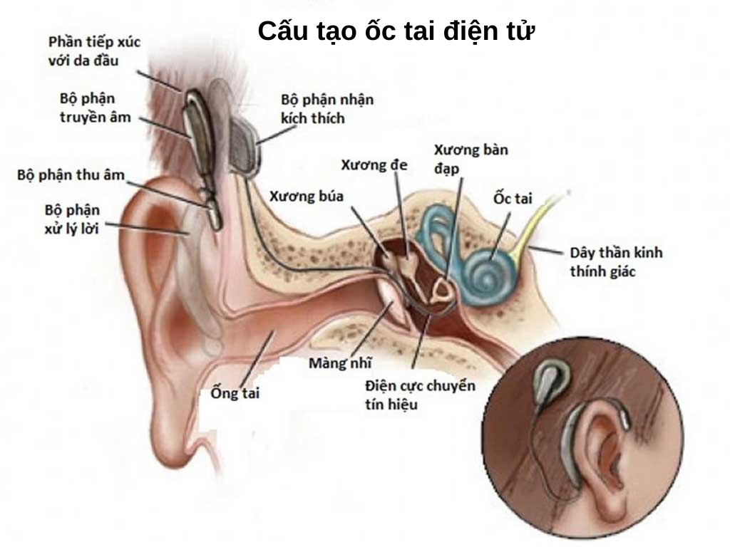 Thuốc và các phương pháp điều trị mất thính lực- Ảnh 5.