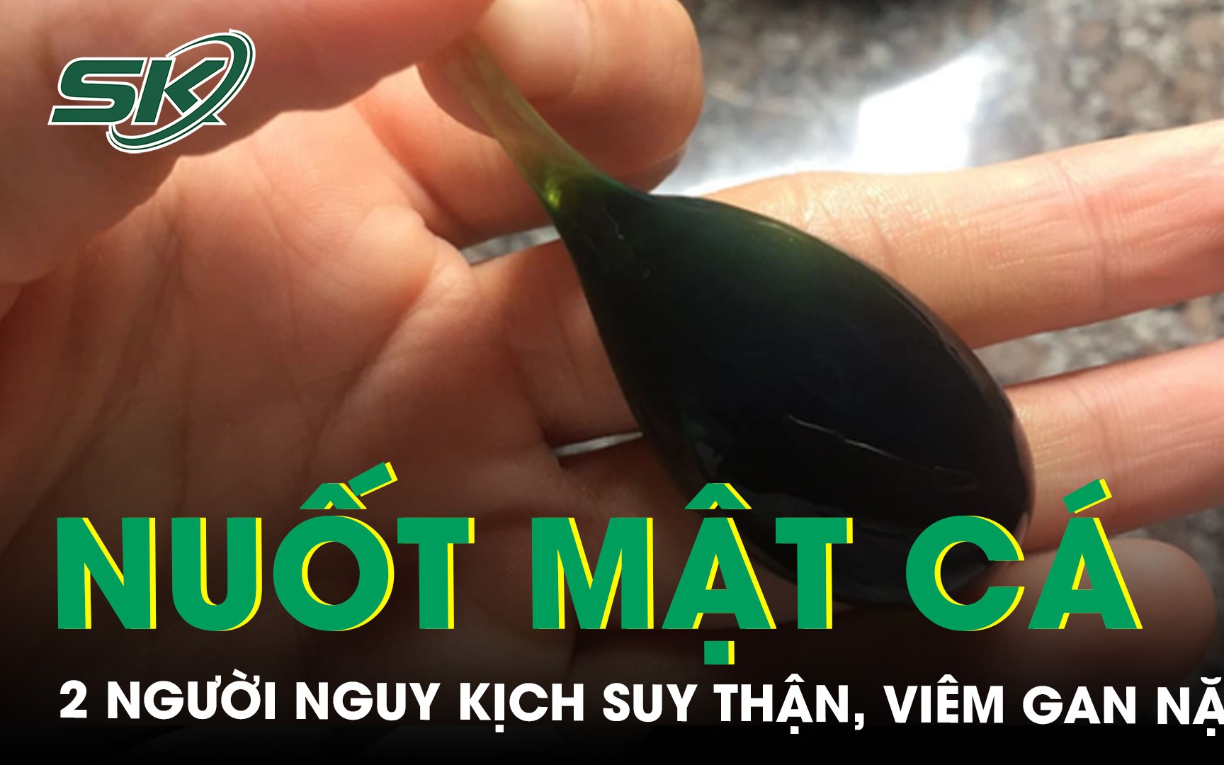 2 người nguy kịch, suy thận, viêm gan nặng do uống mật cá trắm 