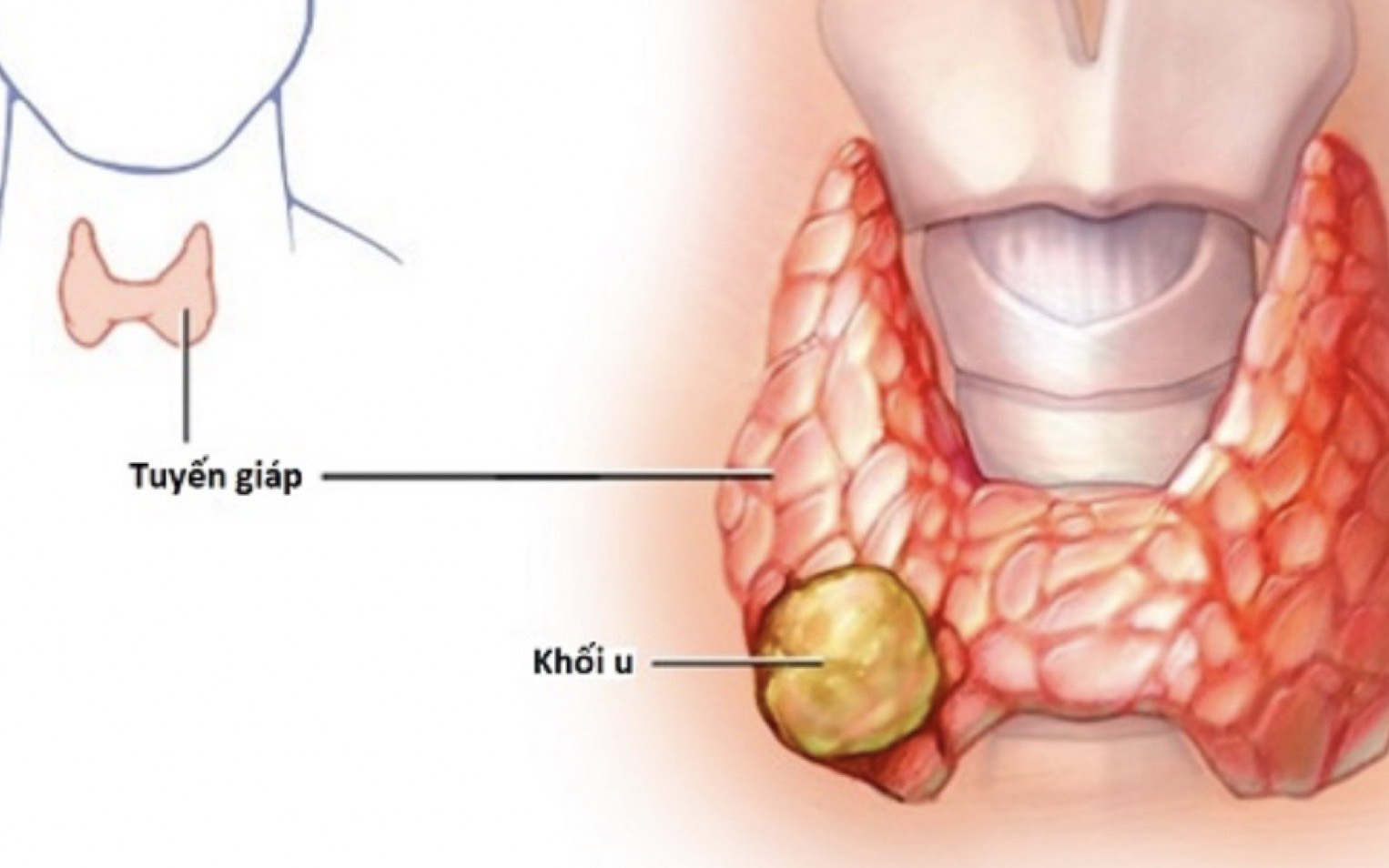 U tuyến giáp Tirads 3 có nguy hiểm không và cách điều trị thế nào?
