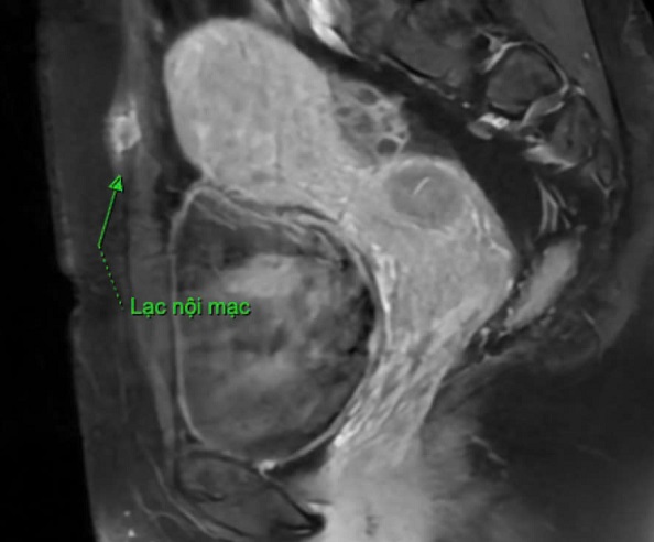 Đốt sóng cao tần chữa lạc nội mạc tử cung- Ảnh 2.