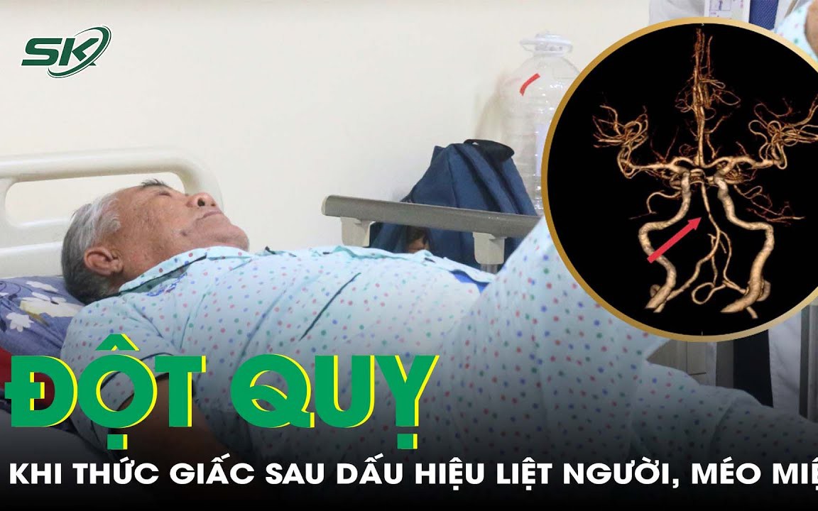 Thức giấc sáng sớm bỗng phát hiện đột quỵ sau dấu hiệu liệt nửa người, méo miệng