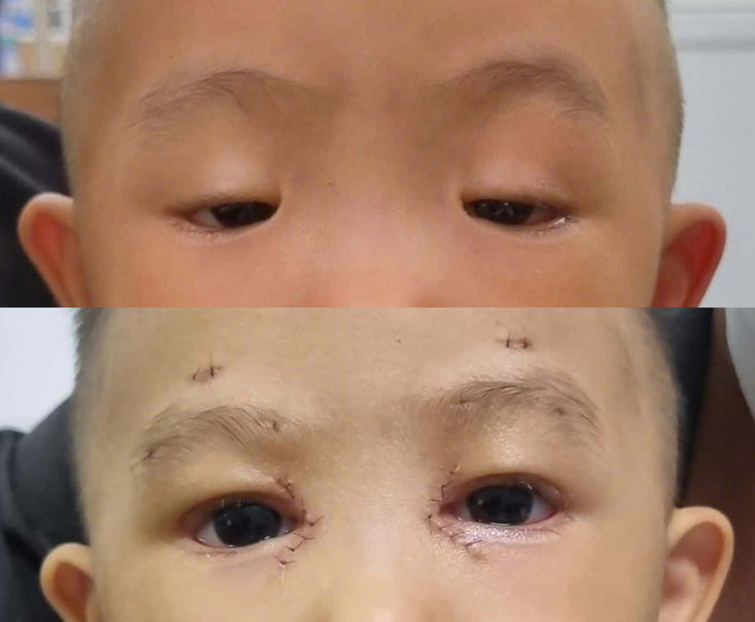 NGƯỜI PHỤ NỮ SOI GƯƠNG QUAN SÁT MÍ MẮT SỤP NHẸ KHÔNG ĐỀU