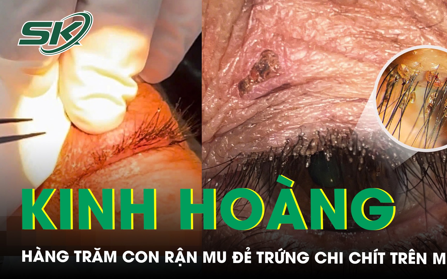 Phát hiện ổ rận mu bám dày trên mí mắt người phụ nữ- Ảnh 2. Kinh hoàng hàng trăm con rận mu làm tổ, đẻ trứng chi chít trên mi mắt