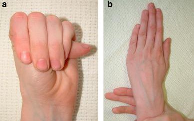 Hội chứng Marfan: Rối loạn di truyền hiếm gặp nhưng nguy hiểm, có thể đe doạ tính mạng- Ảnh 1.