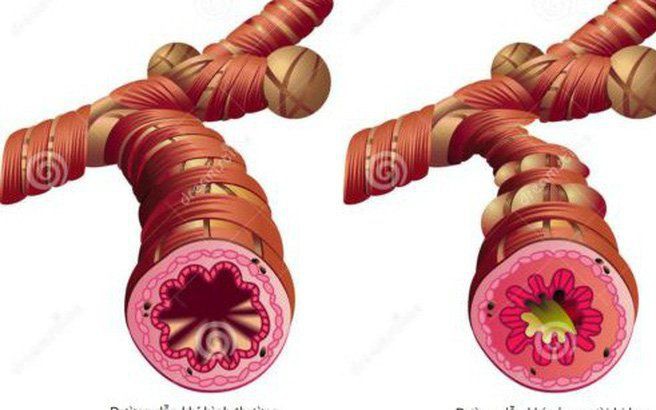 Dấu hiệu cảnh báo cơn hen phế quản cấp tính và cơn hen nguy kịch