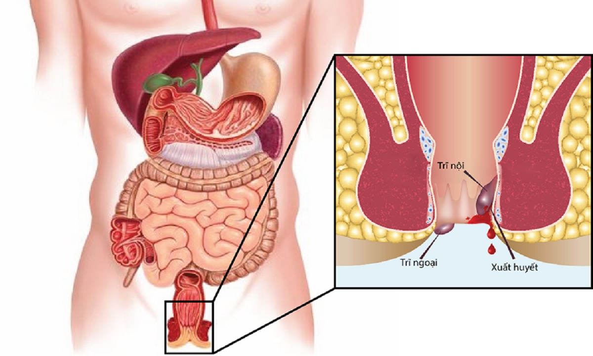 Bệnh trĩ chữa bằng phương pháp nào hiệu quả? cách chăm sóc sau phẫu thuật- Ảnh 1.