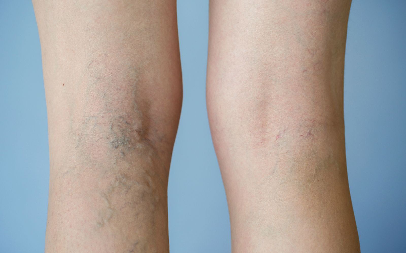 Cách ngăn chặn tiến triển của suy tĩnh mạch chi dưới