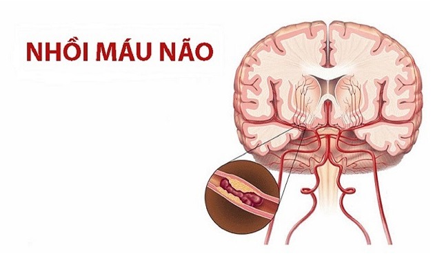 Người bệnh nhồi máu não nên tập luyện thế nào?- Ảnh 1.