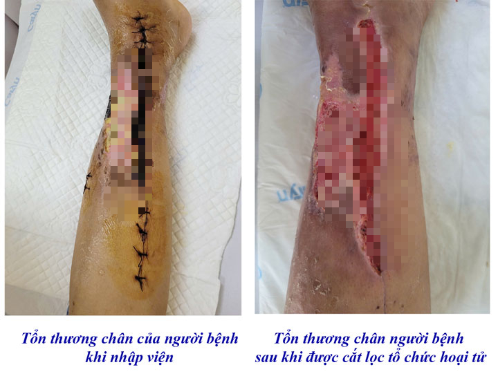 Giảm nguy cơ cắt cụt chi cho bệnh nhân nhờ điều trị bằng máy hút áp lực âm- Ảnh 1.