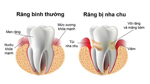 Viêm nha chu có thể gặp ở cả trẻ em và người lớn. Càng để lâu, bệnh càng nguy hiểm, thậm chí người bệnh có thể bị mất răng vĩnh viễn