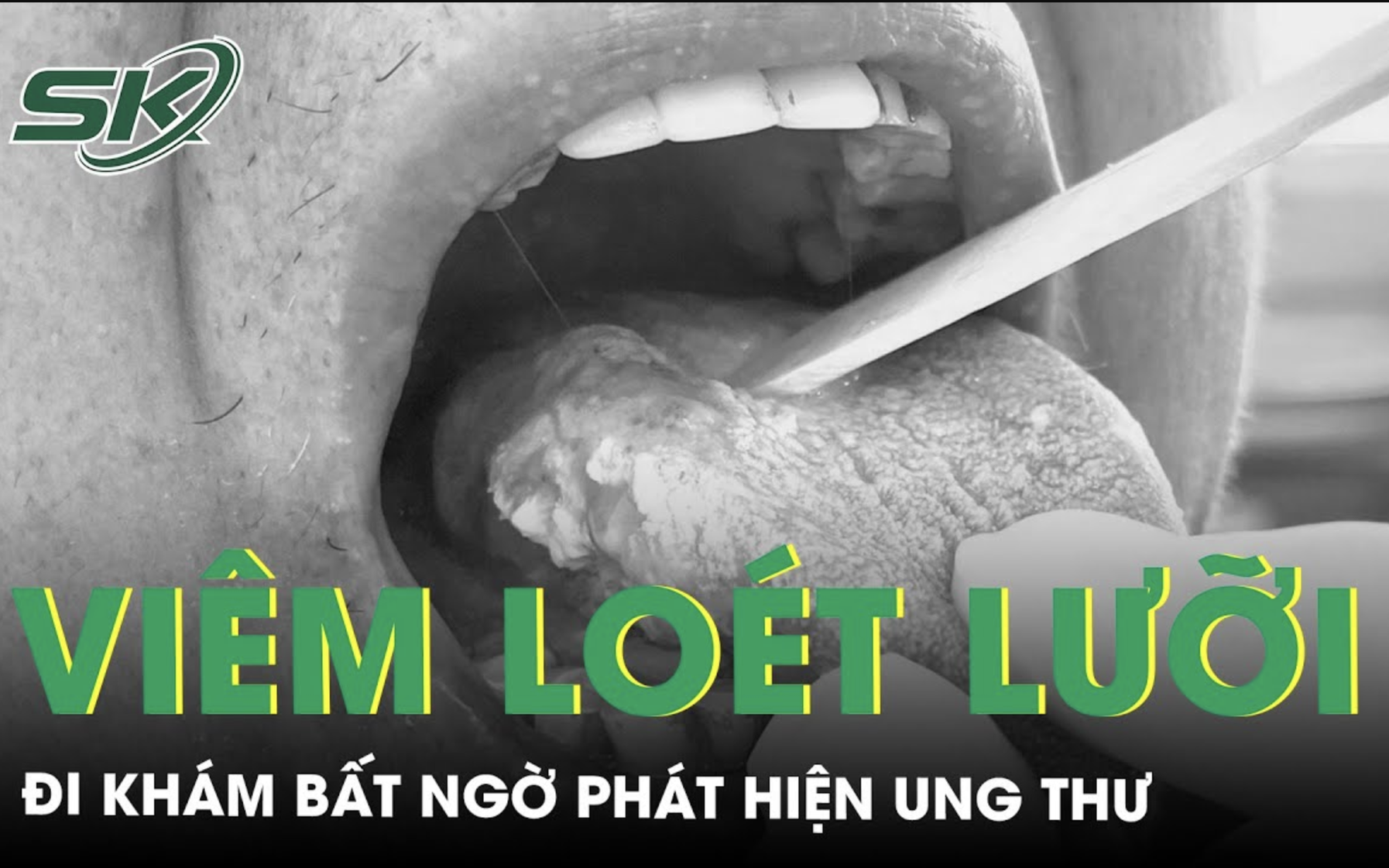 Viêm loét, đau rát lưỡi hơn một tháng đi khám phát hiện ung thư lưỡi 