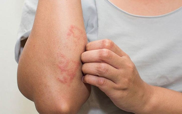 Mùa lạnh cảnh giác với viêm da cơ địa tiến triển nặng