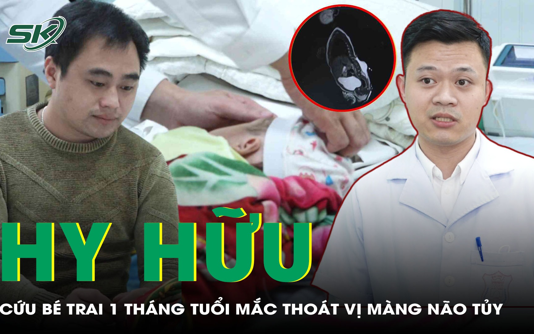 Hồi sinh bé trai 1 tháng tuổi mắc thoát vị màng não tuỷ hiếm gặp 