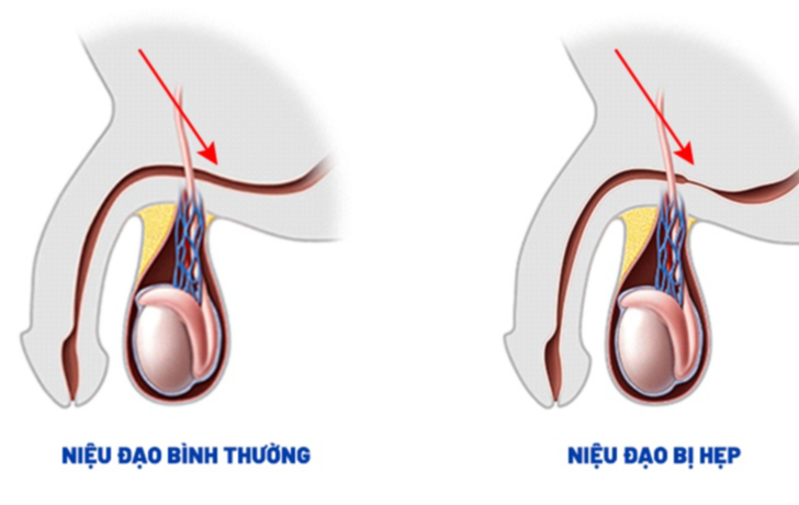 6 câu hỏi thường gặp liên quan đến hẹp niệu đạo- Ảnh 1.