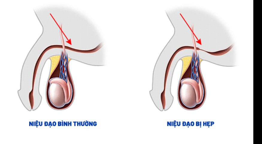 Hẹp niệu đạo: Nguyên nhân, biểu hiện, cách điều trị và phòng bệnh- Ảnh 1.