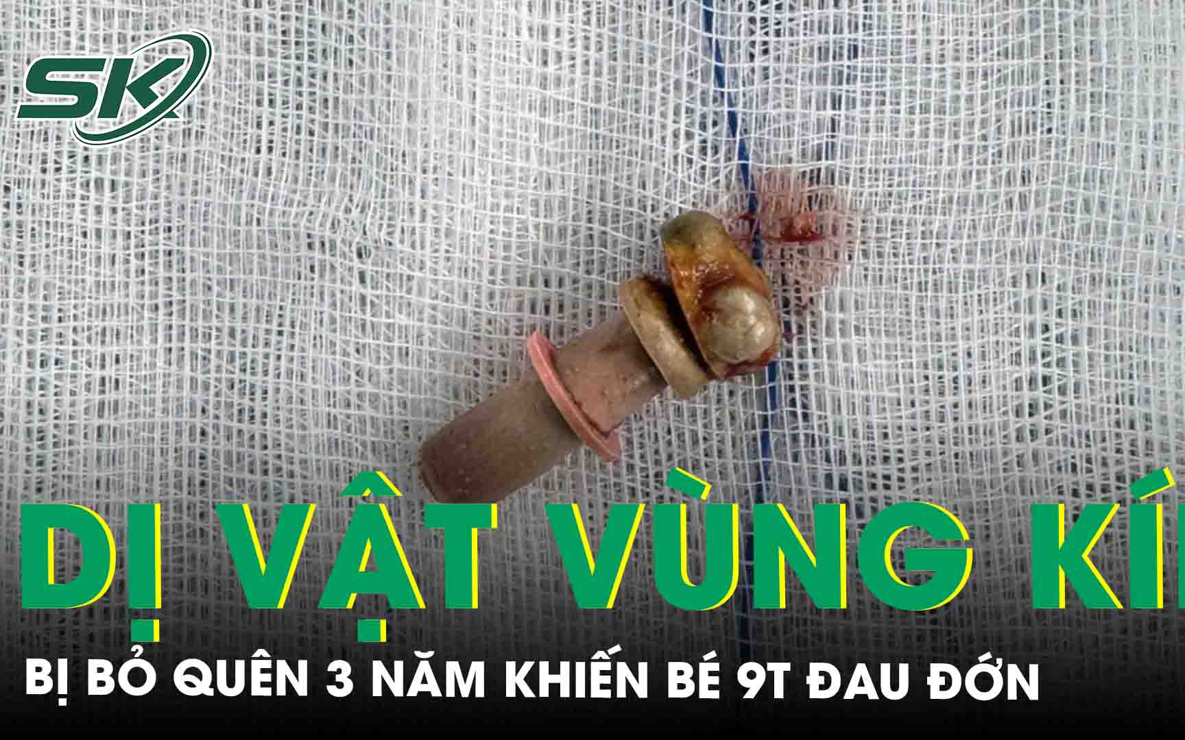 Bé gái 9 tuổi đau đớn vì dị vật để quên 3 năm trong âm đạo 