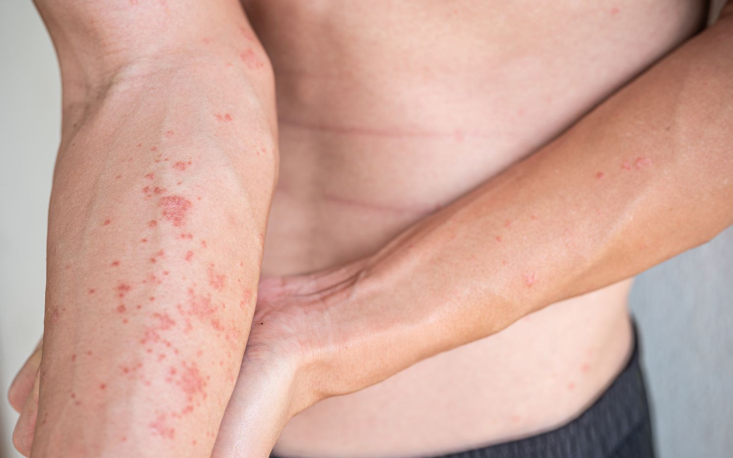 Cảnh giác với viêm da tiếp xúc dị ứng