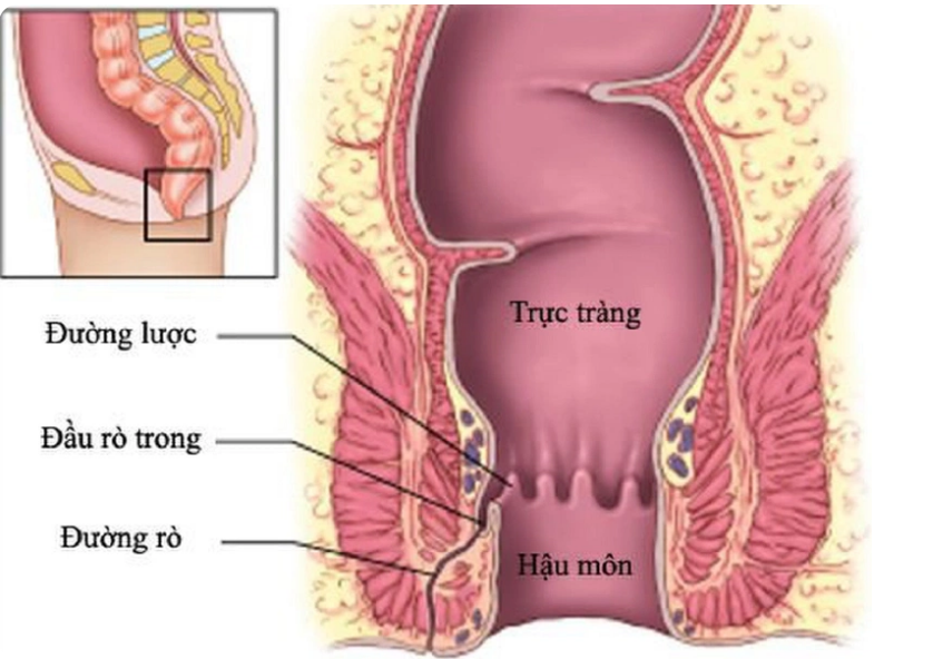 Quan hệ tình dục qua đường hậu môn: Con đường lây nhiễm HIV nguy hiểm nhất, làm sao để bảo vệ bản thân?- Ảnh 1. Quan hệ tình dục qua đường hậu môn: Con đường lây nhiễm HIV nguy hiểm nhất, làm sao để bảo vệ bản thân?- Ảnh 1.