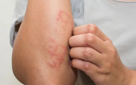 Cách phòng chứng ngứa da, nổi mề đay vào mùa xuân- Ảnh 4. 5 nhóm thực phẩm nên ăn để giảm ngứa da