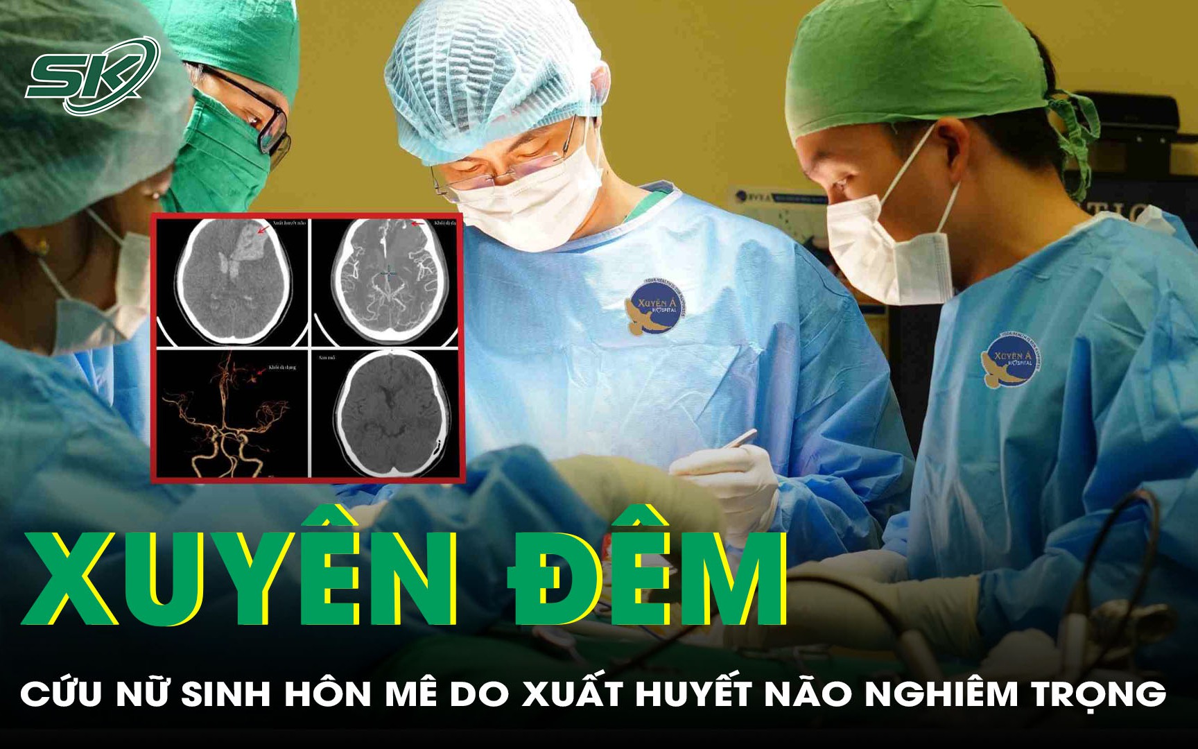 Nguyên nhân gây xuất huyết não- Ảnh 2. Xuyên đêm cứu nữ sinh 16 tuổi hôn mê do xuất huyết não nghiêm trọng