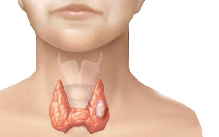 Lý do khiến bạn dễ mắc u tuyến giáp