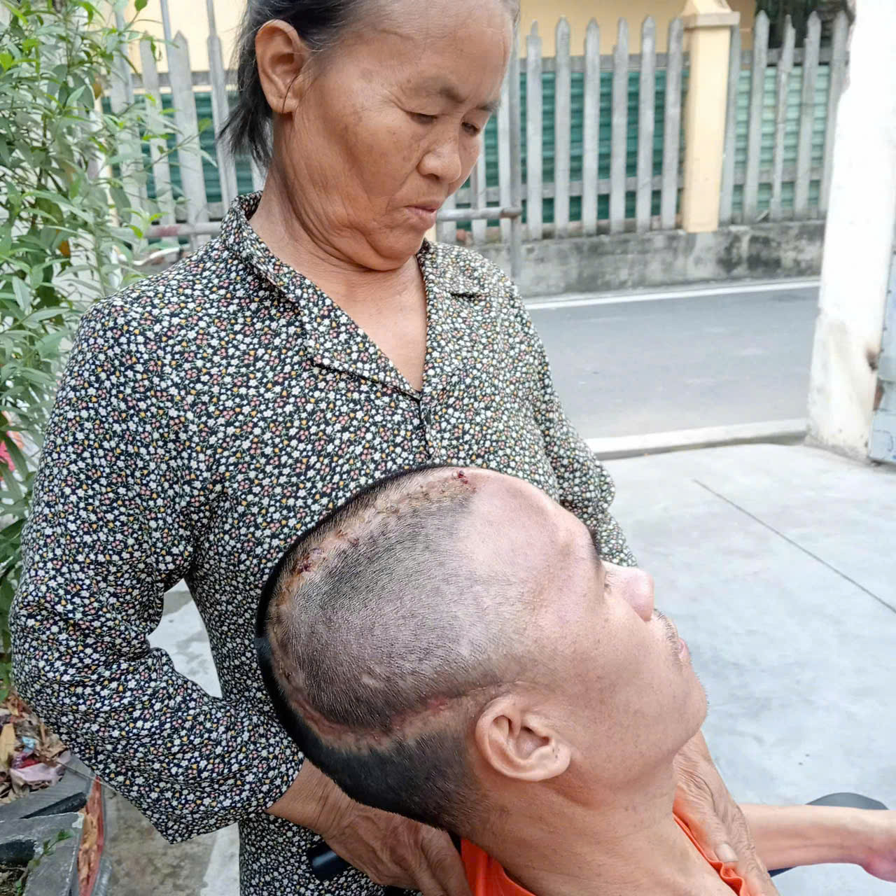 Xót xa hoàn cảnh người đàn ông đơn thân chăm mẹ già và con nhỏ gặp tai nạn nghiêm trọng cần tiền ghép sọ não- Ảnh 1. Xót xa hoàn cảnh người đàn ông đơn thân chăm mẹ già và con nhỏ gặp tai nạn nghiêm trọng cần tiền ghép sọ não- Ảnh 1.