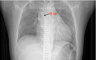 Kim chọc tủy bất ngờ rơi xuống đường thở bé 3 tuổi- Ảnh 3. Vừa xem tivi vừa chơi, bé 13 tuổi nuốt đinh ghim vào đường thở