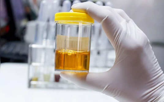 Cách dùng đu đủ xanh loại bỏ axit uric- Ảnh 3. 5 dấu hiệu cảnh báo axit uric cao và sỏi thận, phòng ngừa như thế nào?