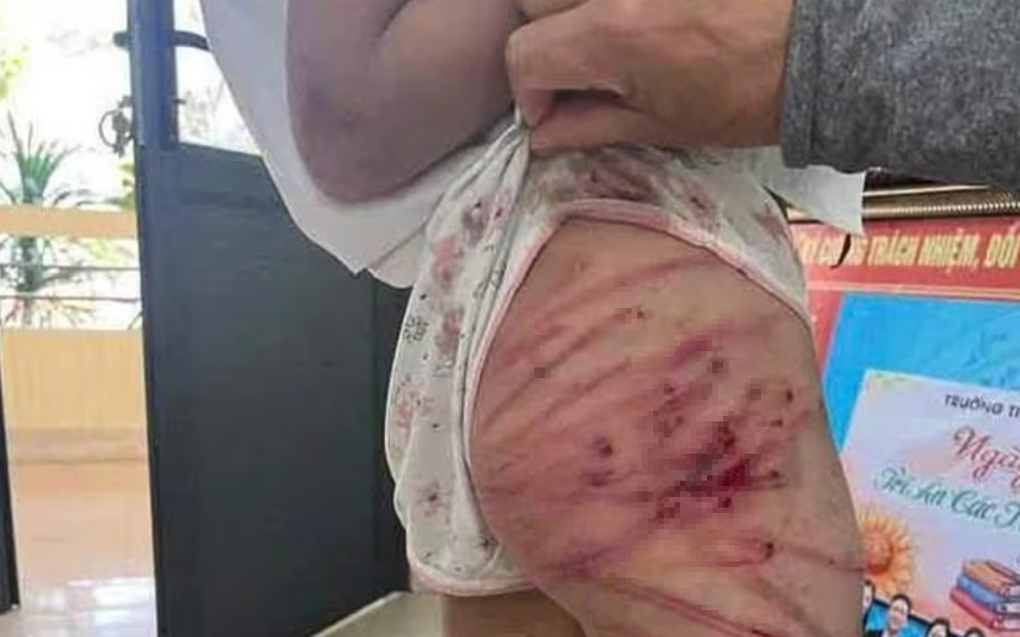 Những vết thương chi chít trên cơ thể của cô bé bị bạo hành- Ảnh 3. Bạo hành trẻ em: Vết thương từ gia đình và rào cản pháp lý