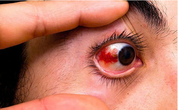 Những bệnh lý tại mắt thường gặp ở người sống chung với HIV- Ảnh 2.