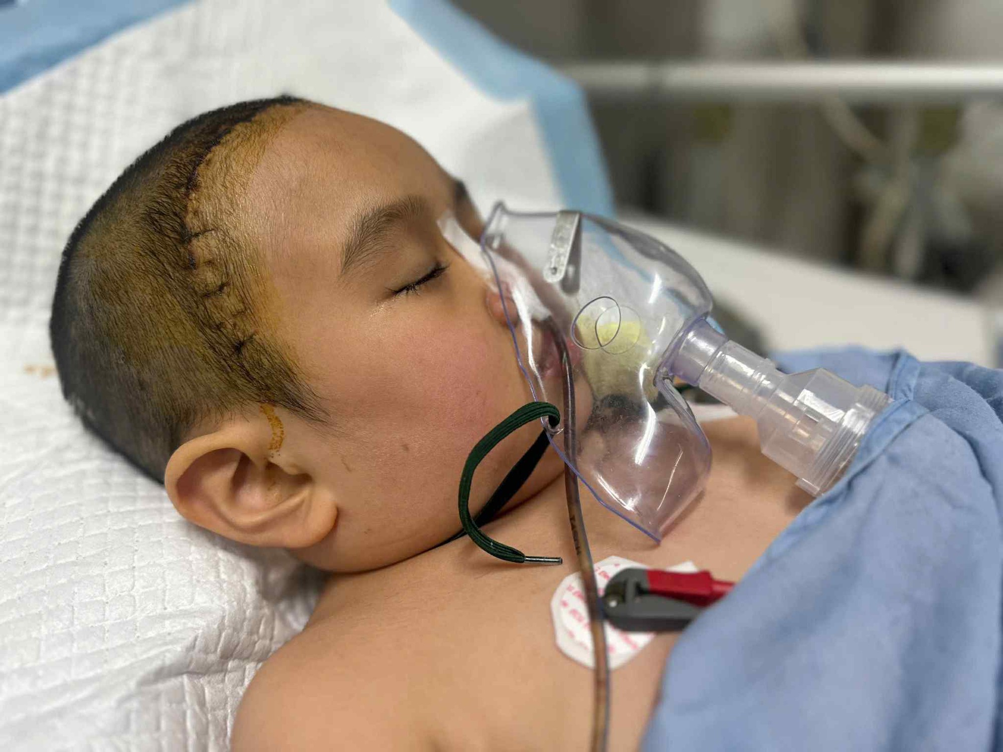 Xót thương hoàn cảnh bé gái mắc bệnh u não cần sự hỗ trợ từ cộng đồng- Ảnh 1. Xót thương hoàn cảnh bé gái mắc bệnh u não cần sự hỗ trợ từ cộng đồng- Ảnh 1.