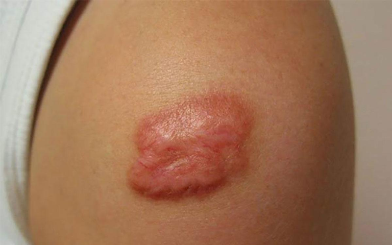 Các yếu tố nguy cơ gây sẹo lồi