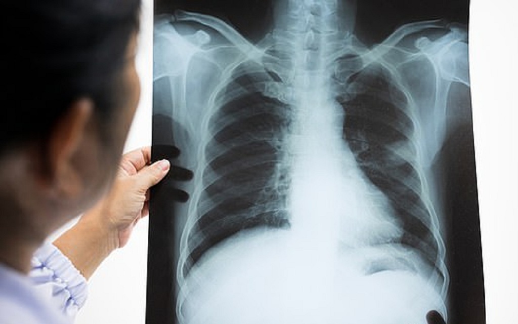 4 bệnh về phổi phổ biến nên biết- Ảnh 2. Bất ngờ phát hiện ung thư phổi khi đi khám sức khỏe định kỳ