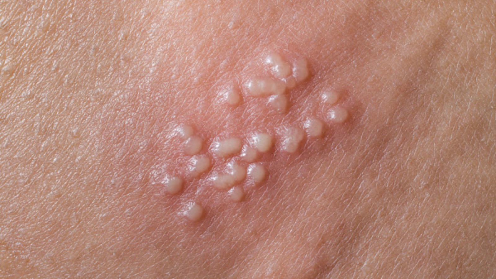 Nguyên nhân gây bệnh mụn rộp sinh dục- Ảnh 1.