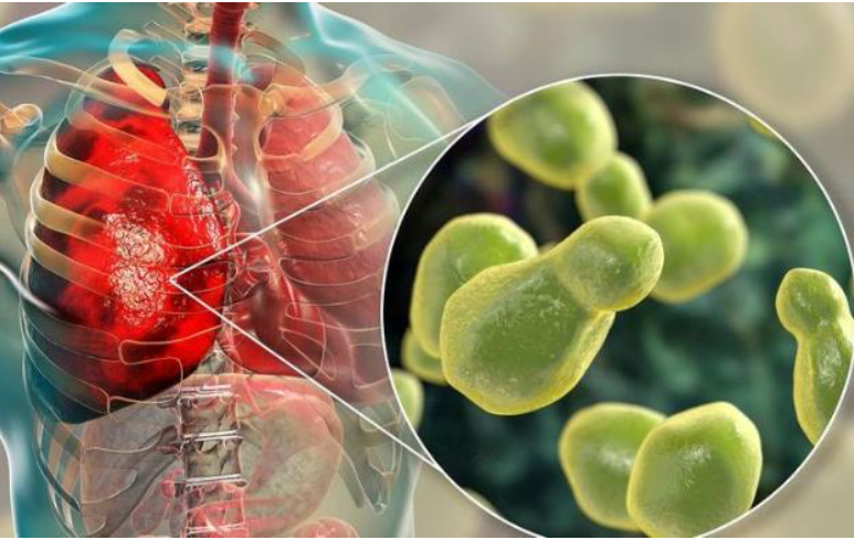 Những bệnh lý tại phổi nào thường gặp ở người nhiễm HIV?- Ảnh 1. phoi