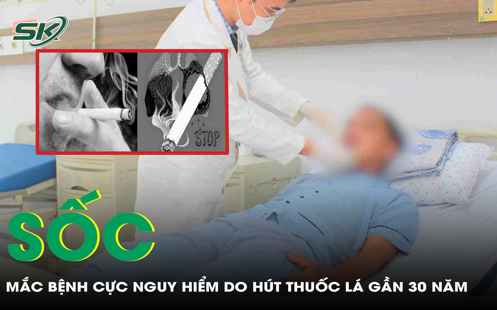 Hút thuốc lá gần 3 thập kỷ, người đàn ông sốc khi phát hiện mắc bệnh cực nguy hiểm