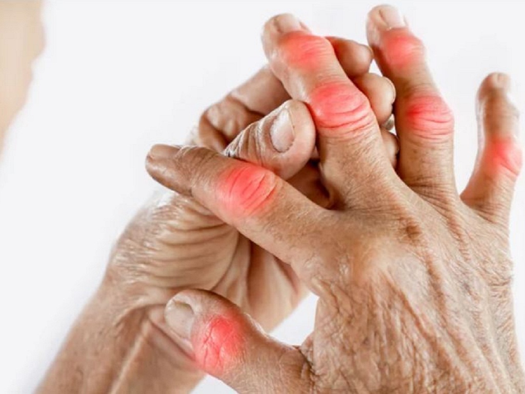 Bị viêm khớp nên ăn gì, kiêng gì?- Ảnh 1. Bị viêm khớp nên ăn gì, kiêng gì?- Ảnh 1.