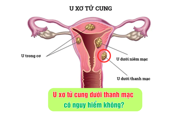 U xơ tử cung dưới thanh mạc có nguy hiểm không?