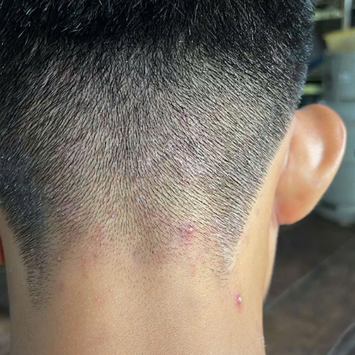 Hiểu đúng về gàu và nấm da đầu – Vì sao càng dùng 'mẹo' dân gian càng nặng?- Ảnh 1.