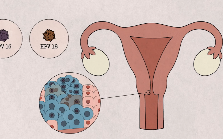 Chủng virus HPV nào dễ gây ung thư cổ tử cung nhất?- Ảnh 4.