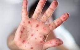 Cảnh giác với nguy cơ bệnh sởi 'trở lại toàn cầu'