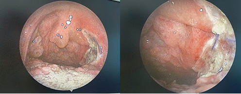 Lấy khối u máu hiếm gặp trong họng bệnh nhi- Ảnh 2.